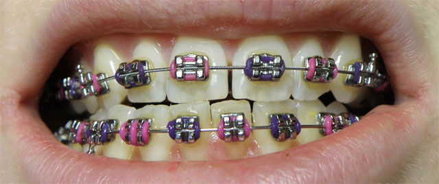 https://upload.wikimedia.org/wikipedia/commons/thumb/e/e1/Orthobraces_-_dental_braces_lower_upper_jaw.jpg/1280px-Orthobraces_-_dental_braces_lower_upper_jaw.jpg