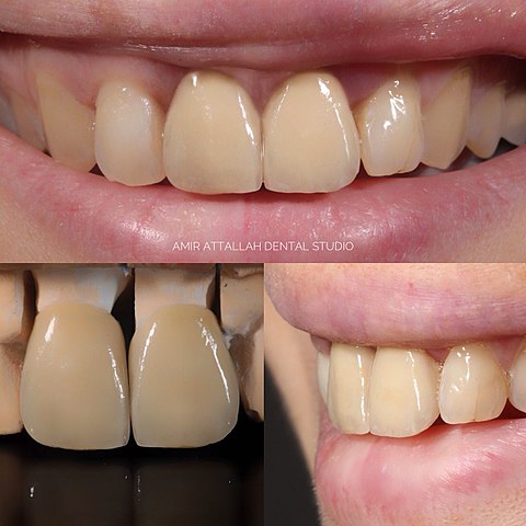 Керамические зубные коронки: https://ru.wikipedia.org/wiki/Стоматологические_коронки#/media/Файл:Feldspathic_VM9_Porcelain_Crowns_-side_view.jpg